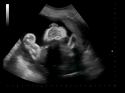 ACUSON P300 Ultrasound System 