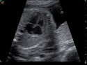 ACUSON X150 Ultrasound System