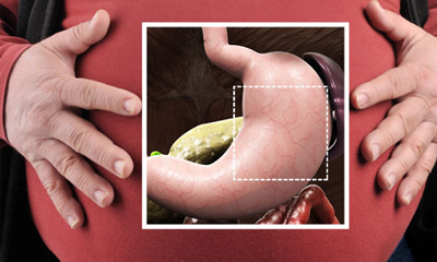 Bariatric surgery