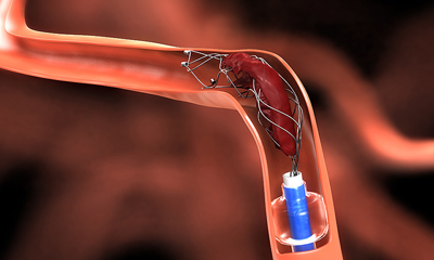 Endo Vascular