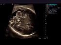 ACUSON S3000 Ultrasound System
