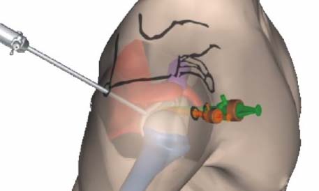 Arthroscopy Equipment