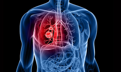 Thoracic Surgery