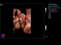ACUSON S1000 Ultrasound System
