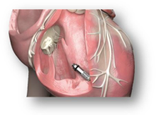 Micra or Leadless Pacemaker 