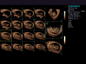 ACUSON S1000 Ultrasound System