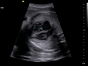 ACUSON X700 Ultrasound System
