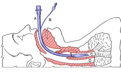 Intubation Equipment