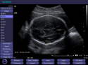 ACUSON X150 Ultrasound System