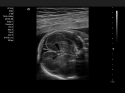 ACUSON X700 Ultrasound System