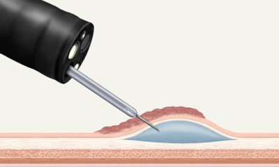Polypectomy,EMR and  ESD